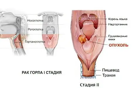 Signs, symptoms, stages and treatment of throat cancer