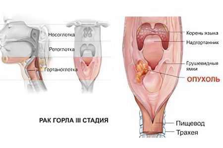 Signs, symptoms, stages and treatment of throat cancer