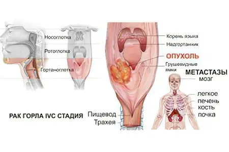 Signs, symptoms, stages and treatment of throat cancer