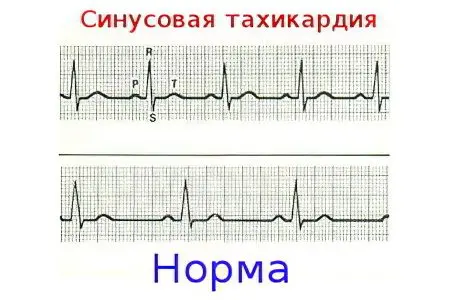 Sinus tachycardia of the heart: how is it treated?