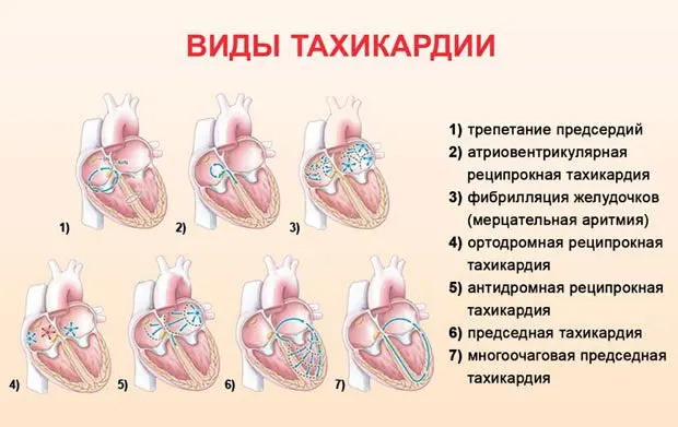 Sinus tachycardia of the heart: how is it treated?