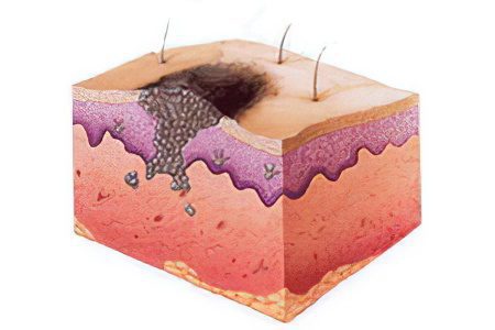 Skin cancer: stages, symptoms and treatment