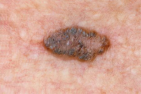 Skin cancer: stages, symptoms and treatment