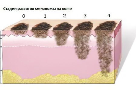 Skin cancer: stages, symptoms and treatment