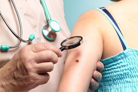 Skin cancer: stages, symptoms and treatment