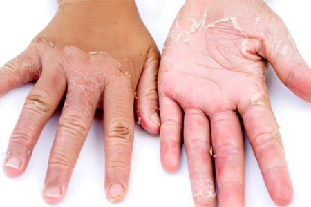 Skin ichthyosis: forms, symptoms and treatment