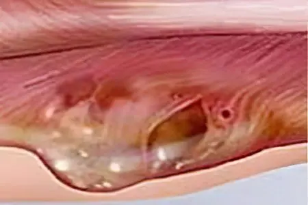 soft tissue sarcoma