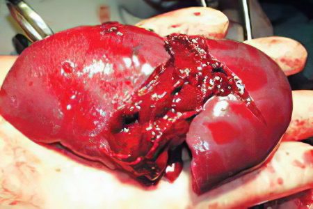 Spleen rupture