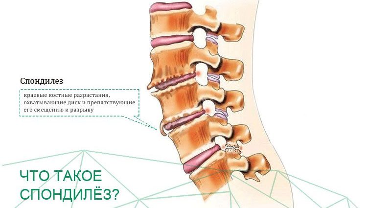 Spondylosis of the spine: stages, symptoms and treatment