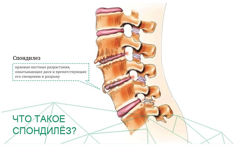 Spondylosis of the spine: stages, symptoms and treatment