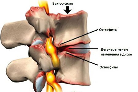 Spondylosis of the spine: stages, symptoms and treatment