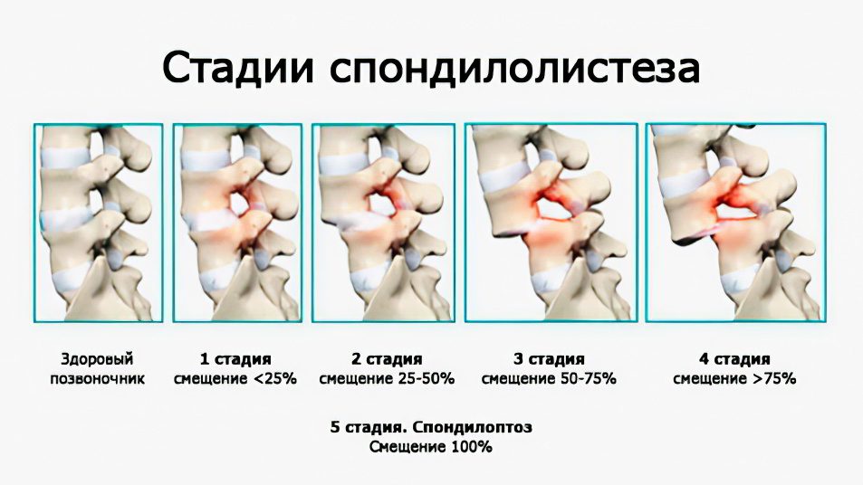 Смещение позвонков. Спондилолистез 3 степени поясничного отдела позвоночника. Спондилолистез III - IV степени. Спондилолистез 1 степени l5 позвонка. Смещение позвонка l5 кпереди.