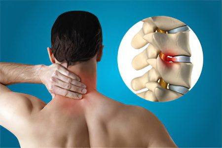 Spondylosis of the spine: stages, symptoms and treatment