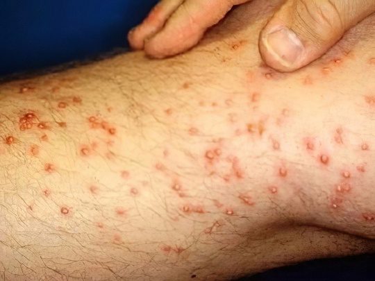 Spots on the body and legs: types, causes of appearance