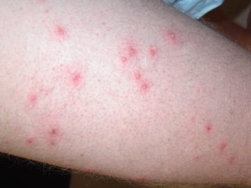 Spots on the body and legs: types, causes of appearance