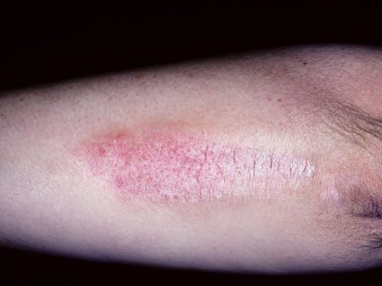 Spots on the body and legs: types, causes of appearance