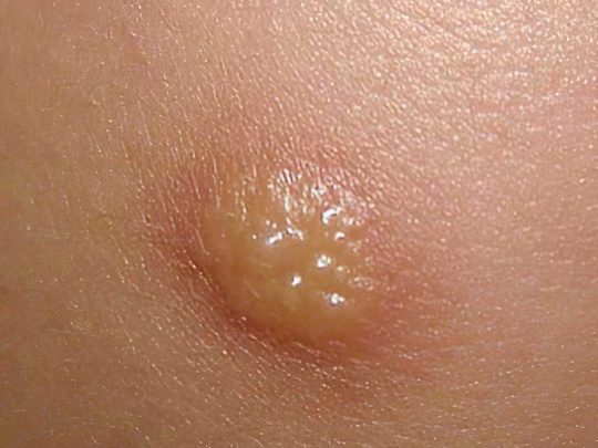 Spots on the body and legs: types, causes of appearance