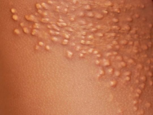 Spots on the body and legs: types, causes of appearance