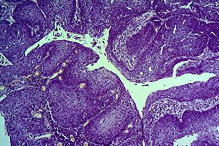 Squamous cell lung cancer