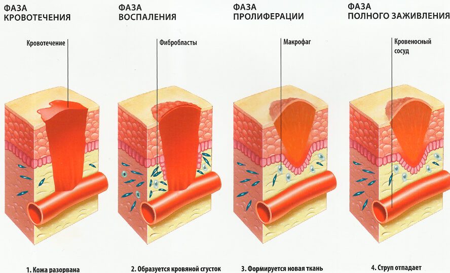 Stages of treatment of open wounds