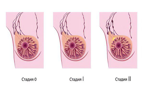 Stages, symptoms, signs and treatment of breast cancer