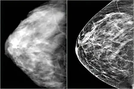 Stages, symptoms, signs and treatment of breast cancer