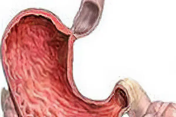 Stenosis of the pylorus of the stomach and esophagus