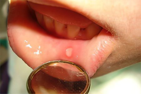 Stomatitis in adults: methods of treatment