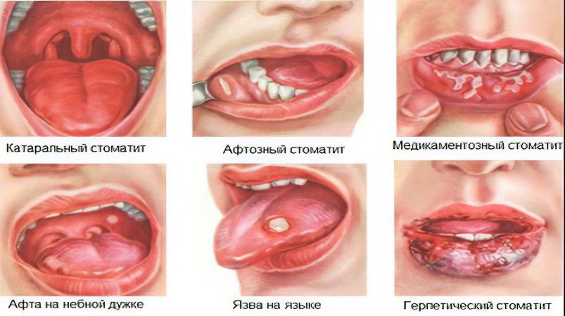 Stomatitis in adults: methods of treatment