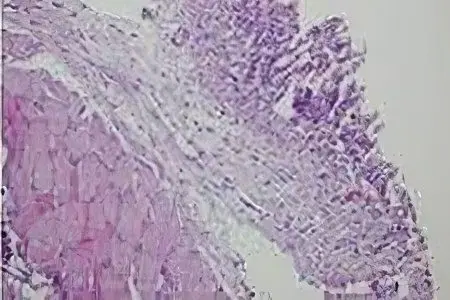 Subcutaneous emphysema