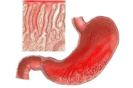 Superficial gastroduodenitis