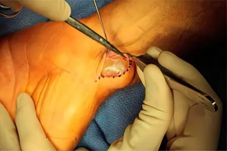 Surgery to remove hygroma