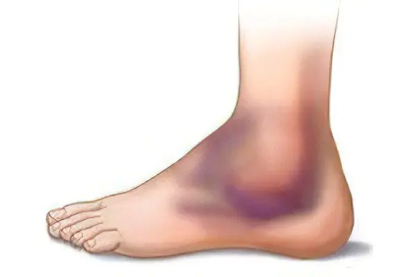 Swelling of the leg after a fracture