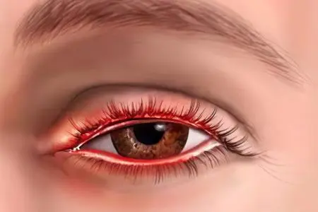 Swelling of the upper and lower eyelids