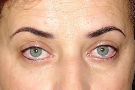 Swelling of the upper and lower eyelids