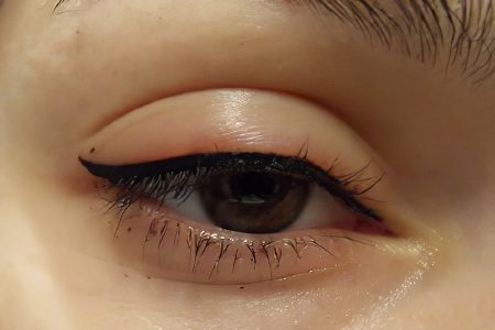 Swelling of the upper and lower eyelids