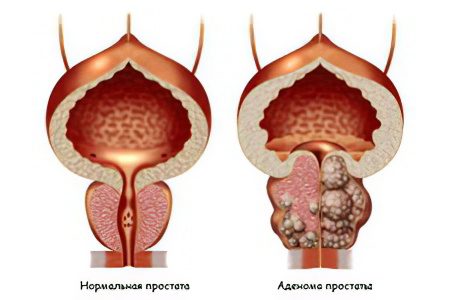 Symptoms and methods of treatment of prostate adenoma in men