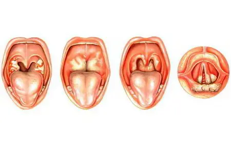 Symptoms and treatment of a throat abscess