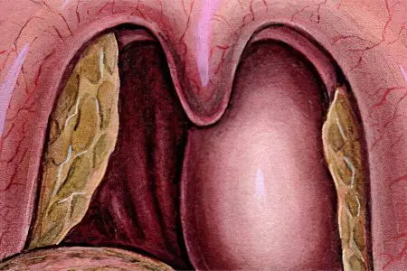 Symptoms and treatment of a throat abscess