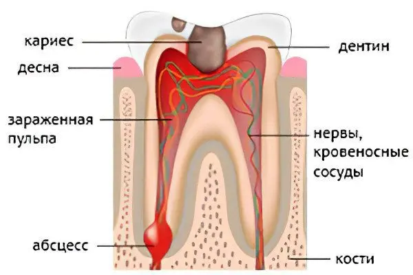 Symptoms and treatment of a tooth abscess