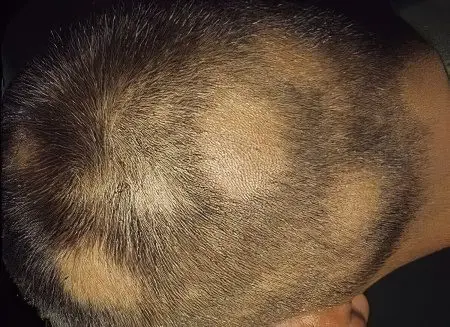 Symptoms and treatment of alopecia areata