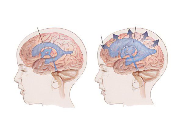 Symptoms and treatment of dropsy of the brain