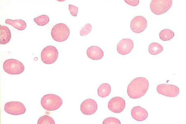 Symptoms and treatment of hemolytic anemia