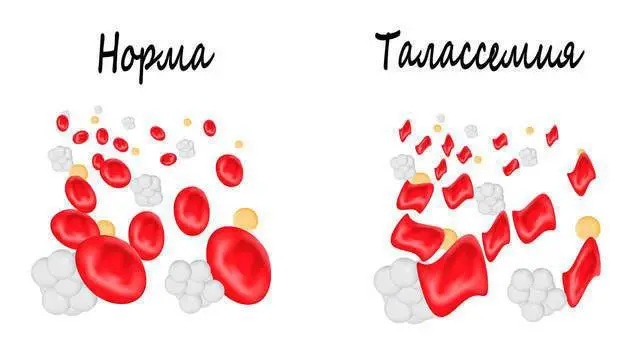 Symptoms and treatment of hemolytic anemia