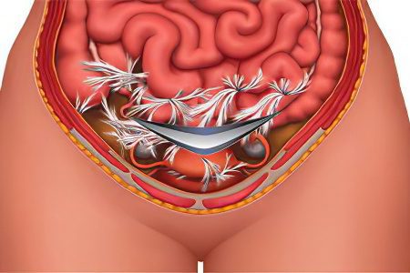 Symptoms and treatment of intestinal adhesions