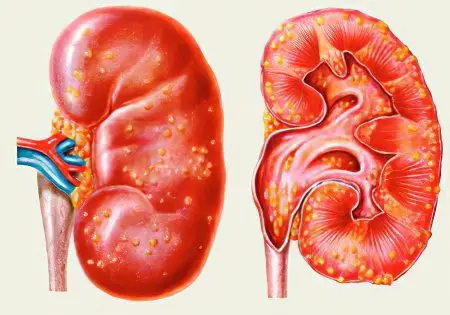 Symptoms and treatment of kidney carbuncle