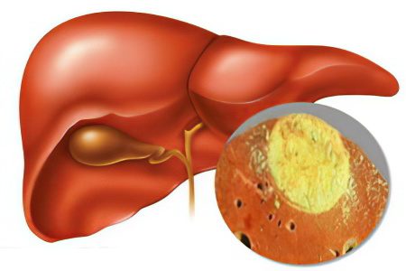 Symptoms and treatment of liver abscess