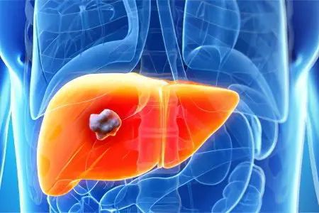 Symptoms and treatment of liver abscess