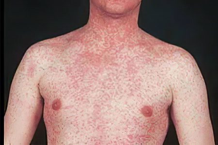 Symptoms and treatment of measles in adults