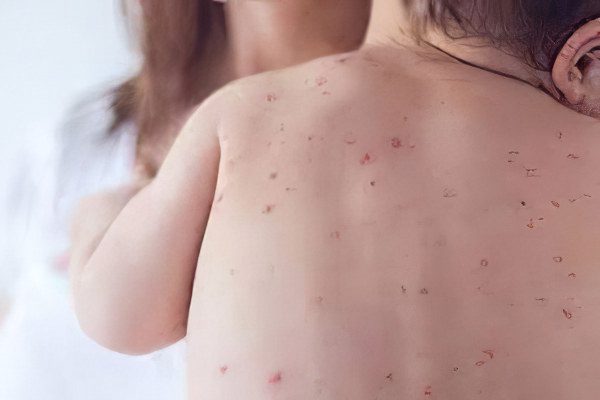 Symptoms and treatment of measles in adults